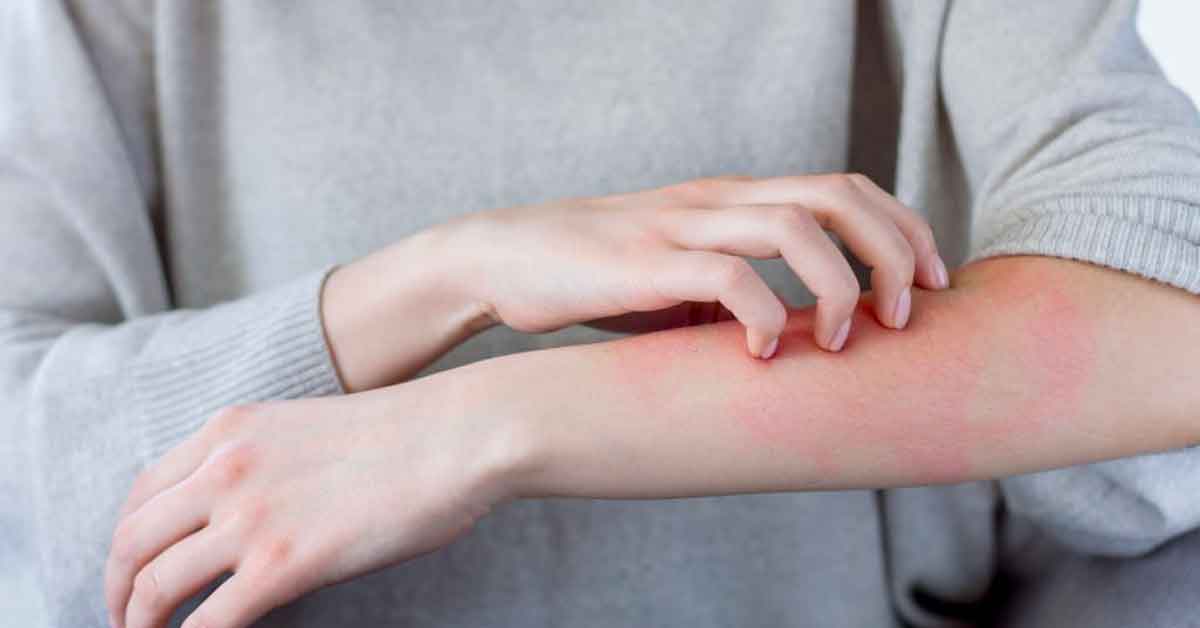 Egzama (Atopik Dermatit) Hastalığı Neden Olur?