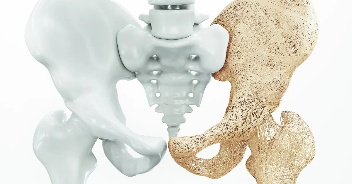 Osteoporoz Genellikle Kimlerde Görülür