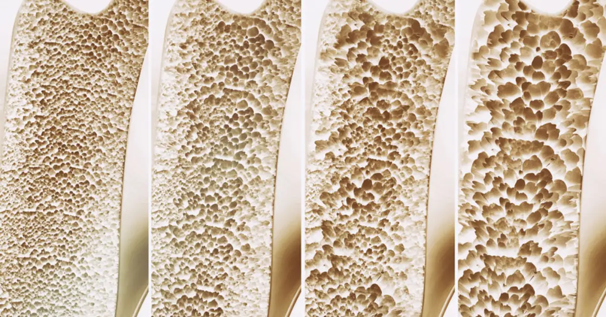 Osteoporoz (Kemik Erimesi) Nedir