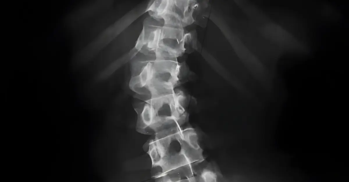 Skolyoz Ameliyatından Sonra Hastanın Dikkat Etmesi Gerekenler